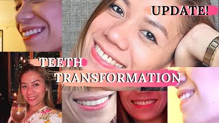 BEFORE and AFTER BRACES  TEETH TRANSFORMATION UPDATE  Part 2  Caryl Dolino [upl. by Demetra]