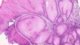 OPath Verrucous Hyperplasia vs Verrucous Carcinoma  by Dr Mithilesh Chandra [upl. by Faro387]