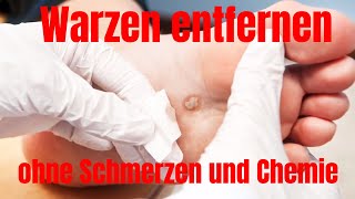 So können Sie Warzen selber entfernen ohne Schmerzen oder Chemie [upl. by Thatcher]