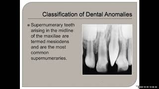 Chapter 7 Dental Anomalies [upl. by Aeet]