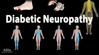 Diabetic Neuropathy Animation [upl. by Leirrad]