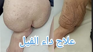 طرق علاج انسداد الاوعيه الليمفاويه وعلاج مرض داء الفيل داخل مصرLymphoedema [upl. by Kimbra145]