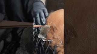 Removing dead skin after chemical peel done by professionals foryou shortvideo removalskin [upl. by Mccafferty]