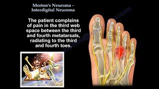 Mortons Neuroma  Interdigital Neuroma  Everything You Need To Know  Dr Nabil Ebraheim [upl. by Neoma489]