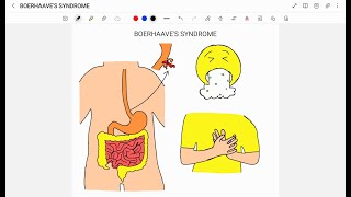 BOERHAAVES SYNDROME [upl. by Francklyn]