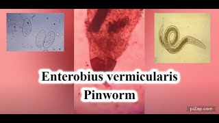 Enterobius vermicularis  Pinworm  Parasitology  pathCast [upl. by Milone]