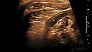 Acute Appendicitis  Ultrasound [upl. by Thanos]