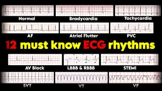 12 must know ECG rhythms  ECGEKG interpretation • Daily Cardiology [upl. by Orelia623]