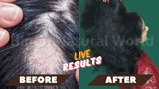 Receding Hairline Regrowth  Hair Regrowth at 40  Regrow Hair After 40 Going Natural from Chemical [upl. by Roanne]