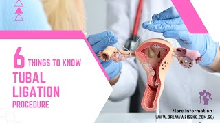 6 Things to Know About Tubal Ligation Procedure [upl. by Marieann]