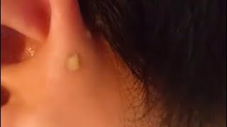 Squeezing preauricular pit clean earpit earsinus pimplepopping [upl. by Dallis263]