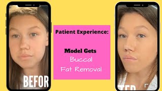 Supermodel Buccal Fat Removal Patient Experience LIFE CHANGING [upl. by Rachelle]