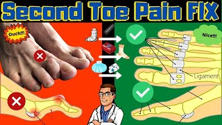 Second Toe Pain TREATMENT Capsulitis Taping amp Freiberg Disease FIX [upl. by Nilac]