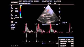 critical care US case studyamazing cranial US [upl. by Swirsky]