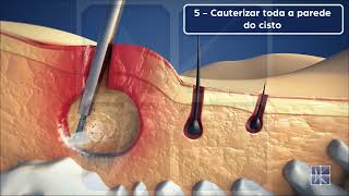 Saúde  Como tratar a inflamação da glândula de Bartholin [upl. by Haikezeh]