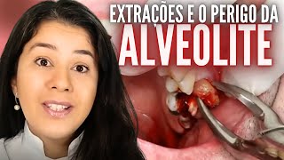 O que fazer após a extração de dente inflamado para não ter alveolite [upl. by Tedmund]