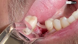 CeraRoot 16 zirconia dental implant placed in the lower right first molar [upl. by Nhguavoj]