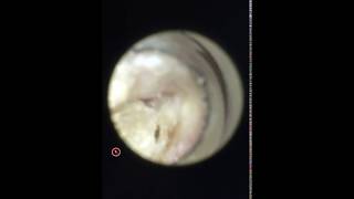 SUMMER SADNESS Swimmers Ear Otitis Externa  Dr Mike Lewis [upl. by Einalam]