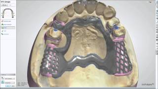 Modellguß im WIELAND 3shape DentalSystem 2013 [upl. by Xenophon]