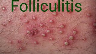 Folliculitis furuncle carbuncle [upl. by Robyn]