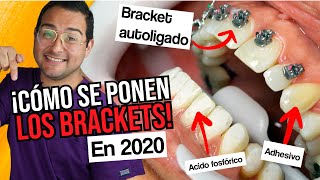 CÓMO SE PONEN LOS BRACKETS en los DIENTES EN 2020  ¡INSTALACIÓN DE ORTODONCIA AUTOLIGADO [upl. by Nussbaum]