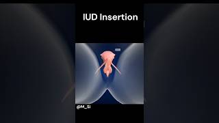 IUD Insertion ye hota h🫣 [upl. by Krasnoff]