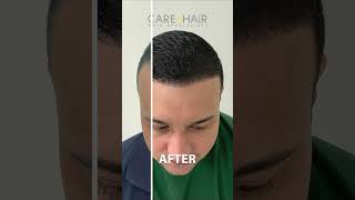 Before and after some patients at Car4Hair hairlosstreatment [upl. by Adair580]