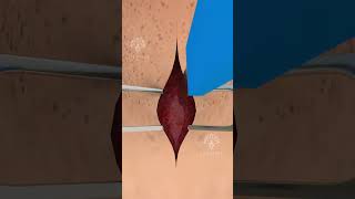 How a Tracheotomy Tube Can Save Lives Hindi shorts viralvideo  Creativelearning3d [upl. by Ydarg293]