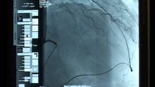 Case 02 Antegrade and Retrograde approach Bilateral Sheathless Radial access [upl. by Rambert]