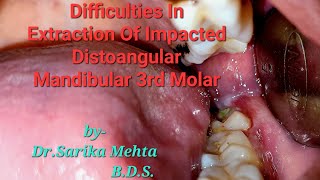 Difficulties In Extraction Of Impacted Distoangular Mandibular 3rd Molar [upl. by Acebber]