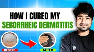 How to cure seborrheic dermatitis  Best treatment for seborrheic dermatitis [upl. by Nyrrat]