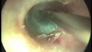 Fluid in middle Ear Serous Otitis Grommet insertionwmv [upl. by Nilam112]