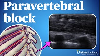 Ultrasound guided thoracic paravertebral block [upl. by Folberth]