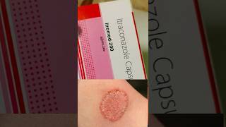 Itraconazole capsule  Itraconazole 100mg  shorts shortvideo ytshorts skincare fungalinfection [upl. by Chrisman]