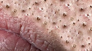 Big Cystic Acne Blackheads Extraction Blackheads amp Milia Whiteheads Removal Pimple Popping  1201 [upl. by Leund852]