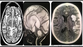 3neuroradiology spotters 15 cases in 15 minutes frcr radiopedia boardexamsmrictxrayanatomy [upl. by Blackmun]