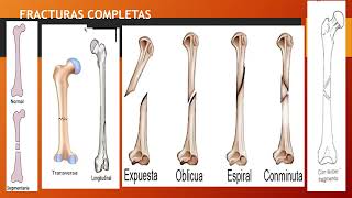 Fracturas Esguinces y Luxacion [upl. by Jaylene494]