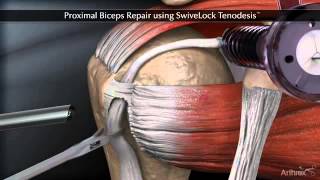 Тенодез сухожилия длинной головки бицепса Proximal Biceps Repair using SwiveLock Tenodesis [upl. by Tenej]