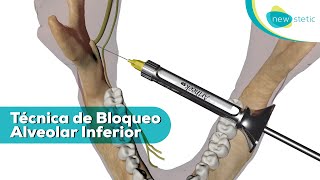 Técnica de bloqueo alveolar inferior 💉 🦷  New Stetic SA [upl. by Idnerb837]