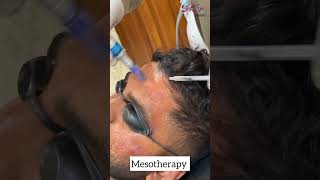 Mesotherapy microneedling mesothmesothprp youtube [upl. by Truitt]