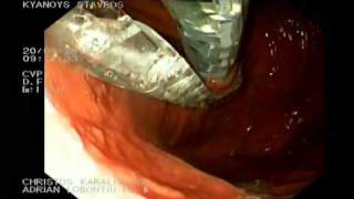 ENDOSCOPIC FUNDOPLICATION ESOPHYX TIF2 PART 1 CHRISTOS KARALIS MDwmv [upl. by Ihp]