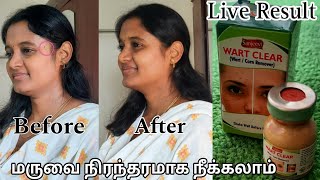 Wart Remover Honest Review in Tamil  வலியே இல்லாமல் மருவை நிரந்தரமாக நீக்கலாம்  Wart Remover Tamil [upl. by Searcy]