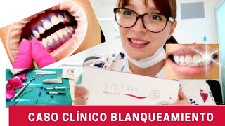 REVIEW Blanqueamiento Dental de Consultorio YOTUEL  Caso Clínico [upl. by Engenia]