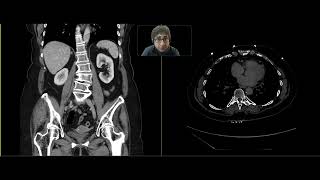 Urothelial neoplasm [upl. by Pascia729]