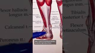 Insertional Achilles Tendonitis [upl. by Casimire]