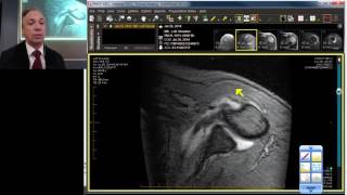 MRI Case Review Shoulder Deep Dive [upl. by Deva557]