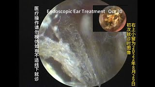 Cholesteatoma followup examination 20231030 [upl. by Eriuqs]