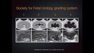 Grading Hydronephrosis on Bedside Ultrasound [upl. by Nalepka133]