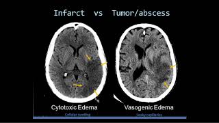 Intro to Head CT Part II Evaluation of Ischemic Stroke [upl. by Irrac]