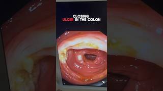 Surgical Treatment for Ulcerative Colon Conditions  Colon Cancer Awareness and Prevention [upl. by Votaw701]